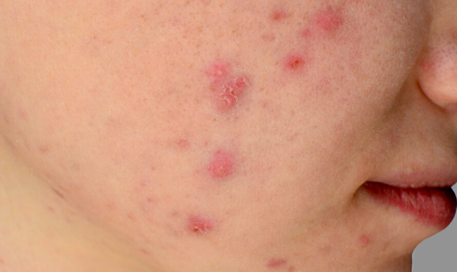 Acne Explained: From Causes to Treatments